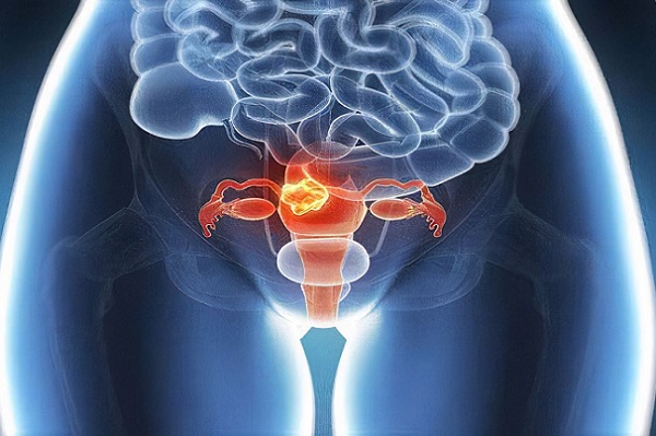 有了卵巢癌靶向药，卵巢癌还可怕吗？